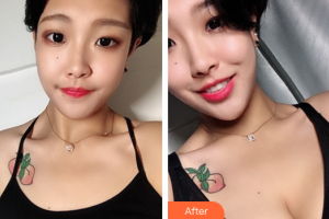 珠海市人民醫(yī)院燒傷整形綜合科羅文福整形價格表附自體脂肪隆胸案例展示