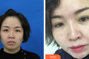 珠?；輴坩t(yī)院整形美容科陳曉華整形價格表附微針美膚案例展示