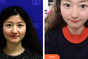 珠?；輴坩t(yī)院整形美容科董仲琴整形價格表附微針美膚案例展示