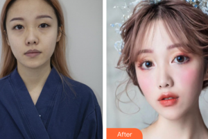 珠海海大整形美容外科黃發(fā)整形價格表附埋線雙眼皮案例展示