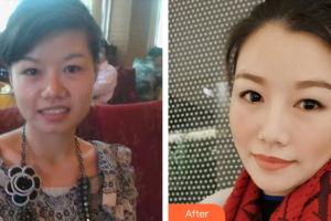 珠海海大整形美容外科葉英梅整形價(jià)格表附點(diǎn)陣激光案例展示