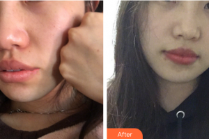 珠海萊茵醫(yī)療美容醫(yī)院權(quán)競元整形價(jià)格表附光子嫩膚案例展示