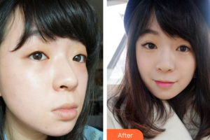 珠海萊茵醫(yī)療美容醫(yī)院周亞莉整形價(jià)格表附超激光美膚案例展示