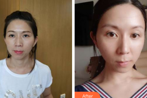 珠海陸達(dá)美容外科醫(yī)院周瑩整形價(jià)格表附埋線提升多方面部案例展示