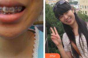 珠海九龍醫(yī)院醫(yī)學(xué)美容科趙璽恩澤整形價(jià)格表附金屬矯正案例展示