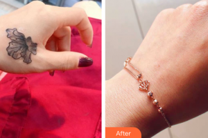 珠海微創(chuàng)外科醫(yī)院姜東求整形價(jià)格表附超激光美膚洗紋身案例展示