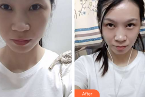 珠海惠愛醫(yī)院整形美容科羅艷紅整形價(jià)格表附眼部修復(fù)案例展示