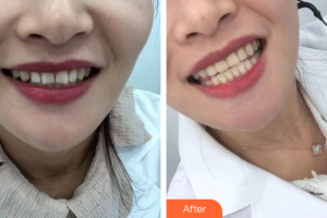 珠海愛思特醫(yī)療美容醫(yī)院韓繼新整形價(jià)格表附口腔美白貼面案例展示