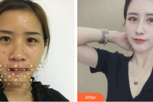 珠海藝星（原仁愛）醫(yī)療美容門診部趙世平整形價(jià)格表附眼鼻部手術(shù)案例展示