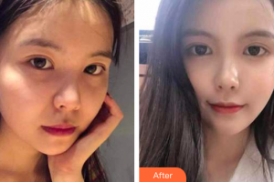 珠海藝星（原仁愛）醫(yī)療美容門診部郭長元整形價(jià)格表附熱瑪吉案例展示