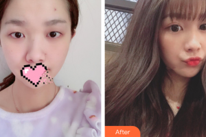 珠海藝星（原仁愛）醫(yī)療美容門診部齊小玲整形價(jià)格表附切開雙眼皮案例展示