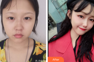 珠海陽光醫(yī)院整形美容中心謝秋萍整形價(jià)格表附埋線提升案例展示