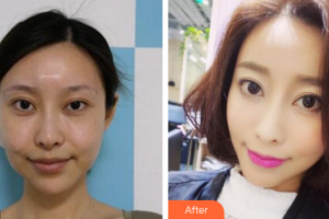 珠海美涵醫(yī)療美容門診部邵偉整形價(jià)格表附埋線提升案例展示