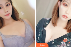 珠海美涵醫(yī)療美容門診部李春雷整形價(jià)格表附自體脂肪隆胸案例展示