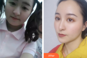 珠海市第二人民醫(yī)院整形美容科黃綺梨整形價(jià)格表附面部吸脂案例展示