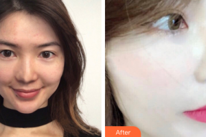 珠海市第二人民醫(yī)院整形美容科夏瓊平整形價(jià)格表附光子嫩膚案例展示