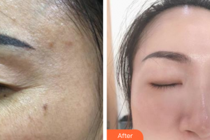 珠海韓妃醫(yī)療美容門(mén)診部李友良整形價(jià)格表附超激光美膚祛斑案例展示