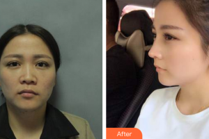 珠海艾瑞醫(yī)療美容醫(yī)院祝小偉整形價(jià)格表附鼻部手術(shù)案例展示