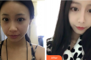 珠海艾瑞醫(yī)療美容醫(yī)院胡國華整形價(jià)格表附鼻部手術(shù)案例展示