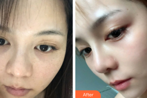 珠海韓妃醫(yī)療美容門(mén)診部曾桂芳整形價(jià)格表附蜂巢激光美膚案例展示