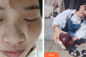 珠海陳科醫(yī)療美容診所覃壽安整形價(jià)格表附激光祛斑案例展示