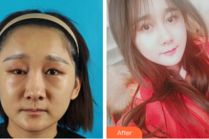 珠海吉大郭閆伏醫(yī)療美容診所張明興整形價(jià)格表附鼻部手術(shù)+埋線(xiàn)提升案例展示