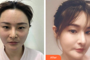 珠海吉大郭閆伏醫(yī)療美容診所薛博今整形價(jià)格表附埋線(xiàn)提升案例展示