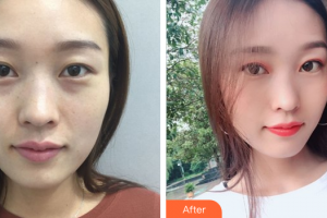 珠海韓妃醫(yī)療美容門(mén)診部項(xiàng)曉飛整形價(jià)格表附鼻部手術(shù)案例展示