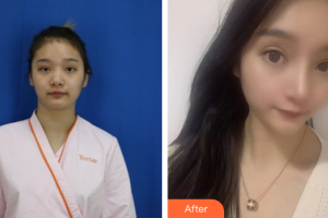 珠海艾瑞醫(yī)療美容醫(yī)院余昌勝整形價(jià)格表附鼻部手術(shù)案例展示