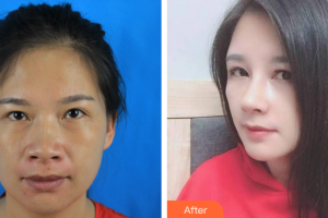 珠海艾瑞醫(yī)療美容醫(yī)院伍展立整形價(jià)格表附鼻部手術(shù)案例展示