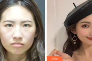 珠海藝星（原仁愛(ài)）醫(yī)療美容門(mén)診部潘智軒整形價(jià)格表附鼻部多項(xiàng)案例展示