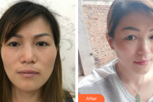 珠海蒂伊醫(yī)療美容門(mén)診部石巍巍整形價(jià)格表附激光祛斑案例展示