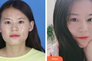 珠海蒂伊醫(yī)療美容門(mén)診部林戈亮整形價(jià)格表附微針祛痘案例展示
