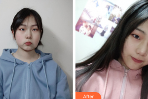 珠海愛(ài)思特醫(yī)療美容醫(yī)院周潔松整形價(jià)格表附埋線(xiàn)提升案例展示