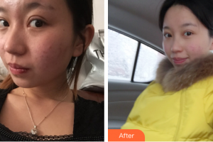 珠海愛(ài)思特醫(yī)療美容醫(yī)院李晶整形價(jià)格表附光子嫩膚案例展示