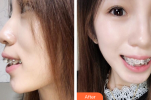 珠海拜博口腔醫(yī)院賴(lài)春光整形價(jià)格表附自鎖托槽矯正案例展示