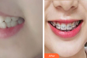 珠海拜博口腔醫(yī)院吳曉飛整形價(jià)格表附自鎖矯正案例展示