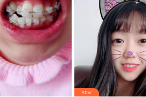 珠海拜博口腔醫(yī)院葉瀚整形價(jià)格表附陶瓷矯正案例展示