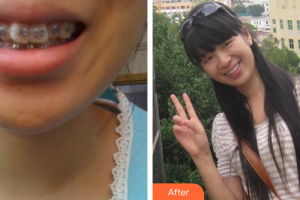 珠海拜博口腔醫(yī)院付冬整形價(jià)格表附金屬矯正案例展示