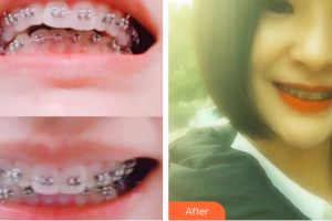 珠海拜博口腔醫(yī)院秘雙燕整形價(jià)格表附金屬矯正案例展示