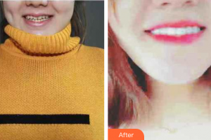 珠海拜博口腔醫(yī)院閻璐整形價格表附瓷貼面案例展示