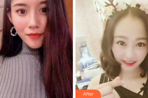 珠海拜博口腔醫(yī)院黃東整形價(jià)格表附超聲波洗牙案例展示