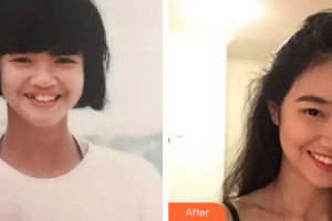 珠海拜博口腔醫(yī)院鄧勝靈整形價格表附金屬矯正案例展示