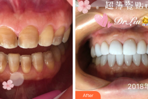 珠海拜博口腔醫(yī)院廖越奇整形價格表附瓷貼面案例展示