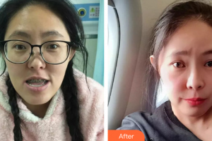 珠海拜博口腔醫(yī)院趙陽整形價格表附金屬矯正案例展示