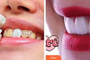 珠海拜博口腔醫(yī)院金晶整形價格表附瓷貼面案例展示