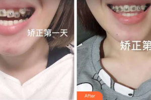 珠海拜博口腔醫(yī)院黎玲玲整形價格表附牙齒矯正案例展示
