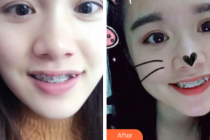 珠海拜博口腔醫(yī)院張立超整形價格表附金屬矯正案例展示