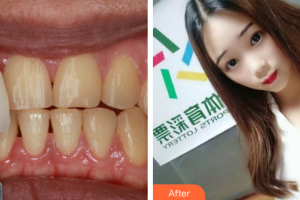 珠海優(yōu)里卡齒科門診部畢春英整形價格表附牙齒隱形矯正案例展示