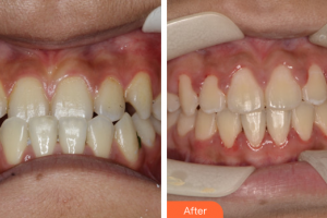 珠海建輝口腔診所鐘建輝整形價格表附自鎖矯正案例展示